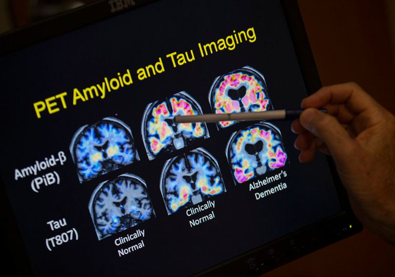 Eli Lilly-ის პრეპარატი ალცჰაიმერის პროგრესირებას სამჯერ ანელებს